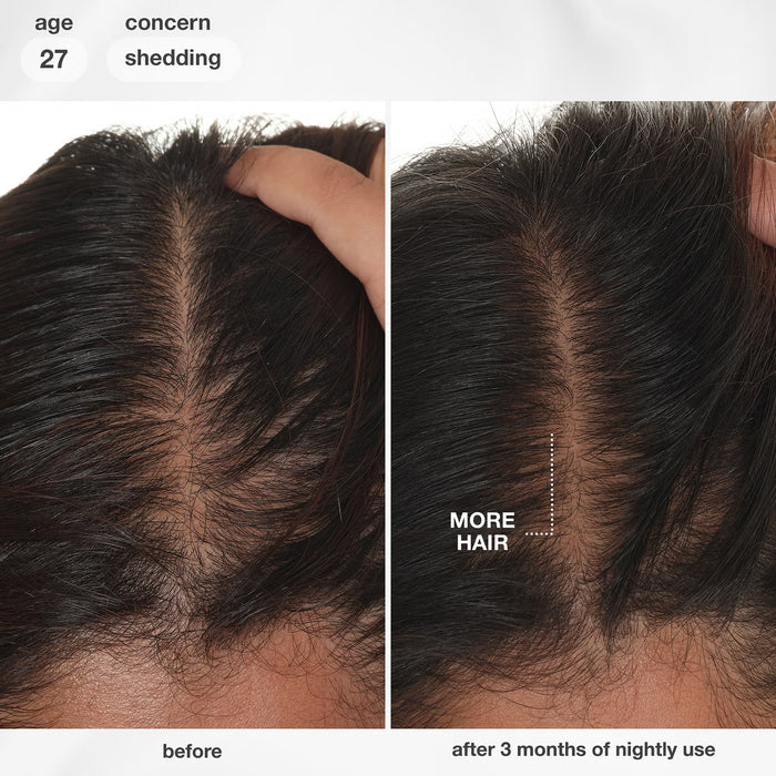 K18 Future IQ before and after scalp results showing fuller hair density and reduced shedding after 3 months of nightly use.