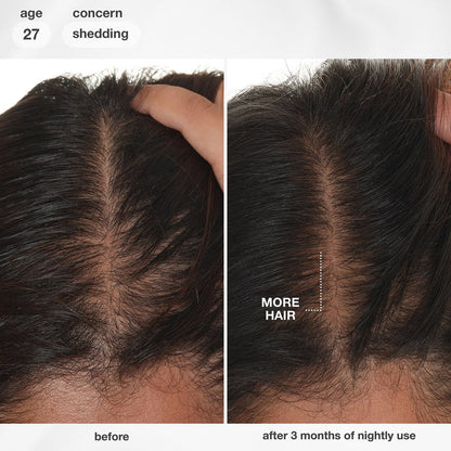 K18 Future IQ before and after scalp results showing fuller hair density and reduced shedding after 3 months of nightly use.